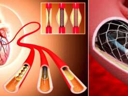 angiogram