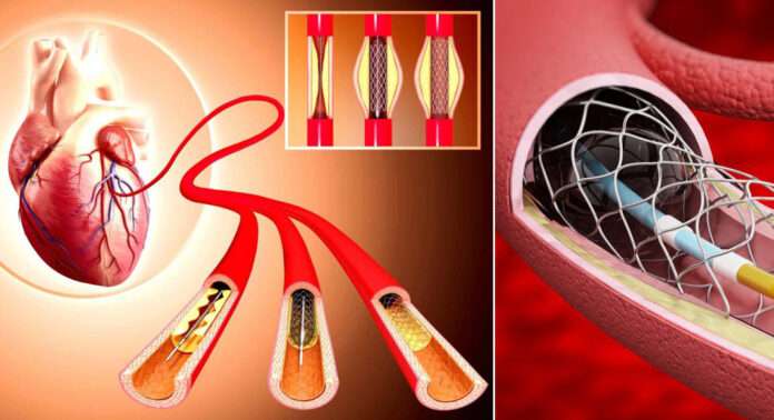 angiogram